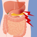 Coping Strategies for Dealing with Abdominal Pain in Cyclic Vomiting Syndrome